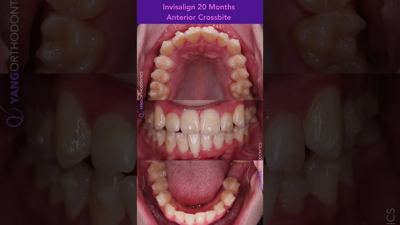 20 months with Invisalign to fix severe crowding & anterior crossbite&mdash;no extractions! 🦷✨#invisalign