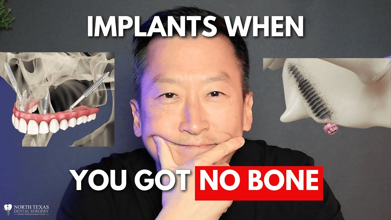 Zygomatic & Pterygoid Implants Explained: Extreme Solutions for Severe Bone Loss