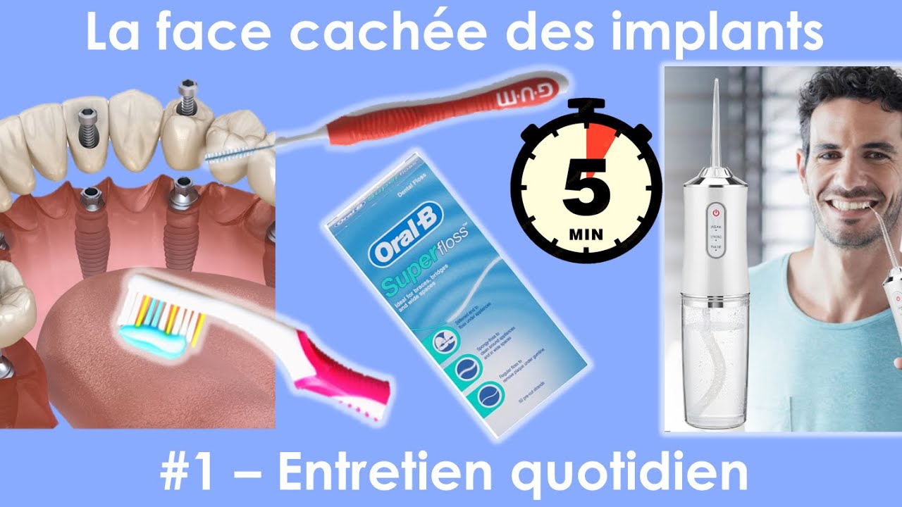 La face cachée des implants dentaires - #1 - Entretien quotidien