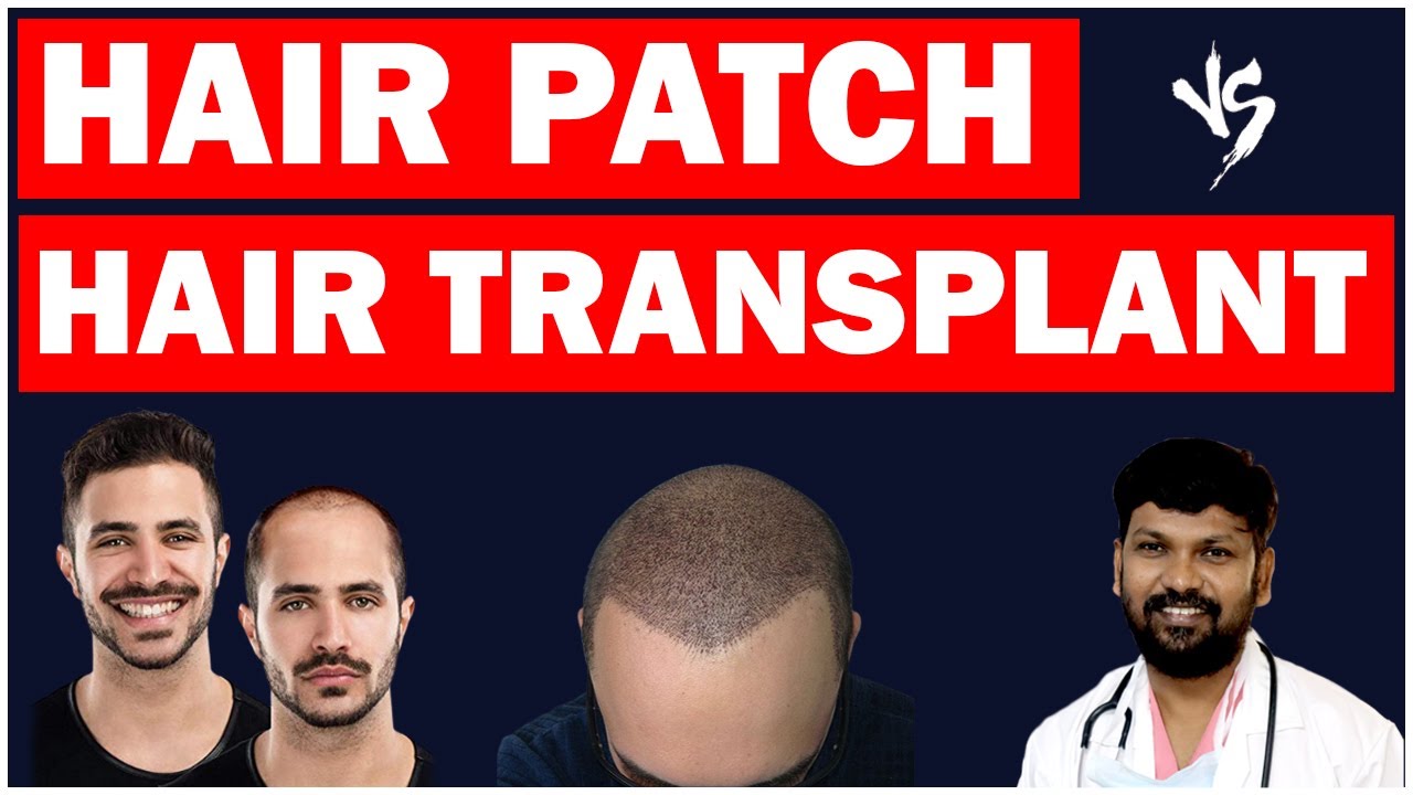 #DrJohnWatts | Hair Transplant Vs Hair Patch: Which is Better? | Best Hair Transplant Expert Explain