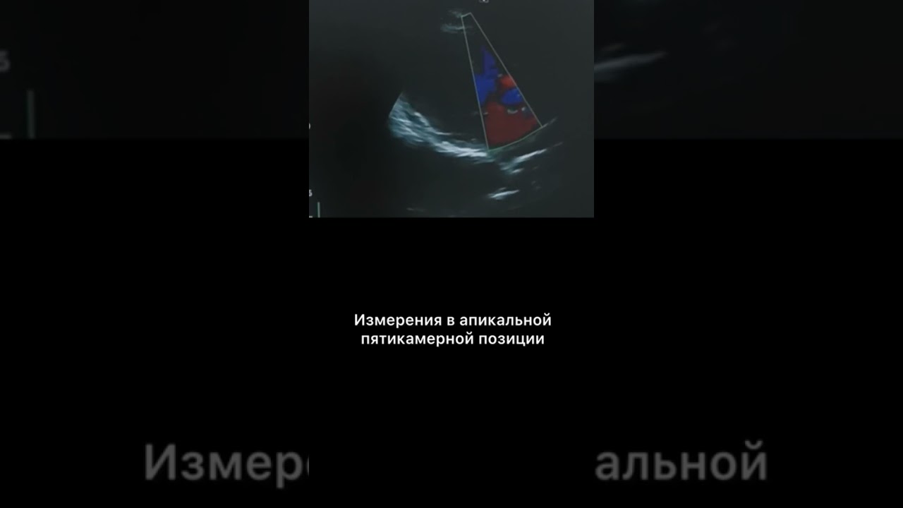 #аортальнаярегургитация #узисердца