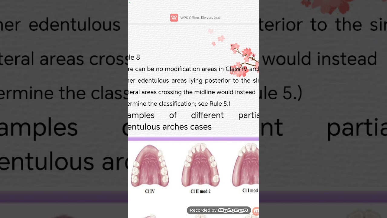prosthedontics Third stage Kennedy Classification صناعة الأسنان المرحلة  الثالثة