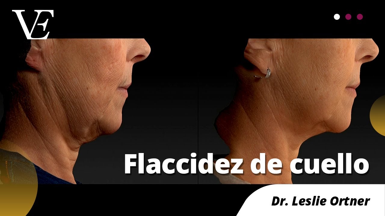 FLACCIDEZ DE CUELLO, TRATAMIENTO SIN CIRUGIA