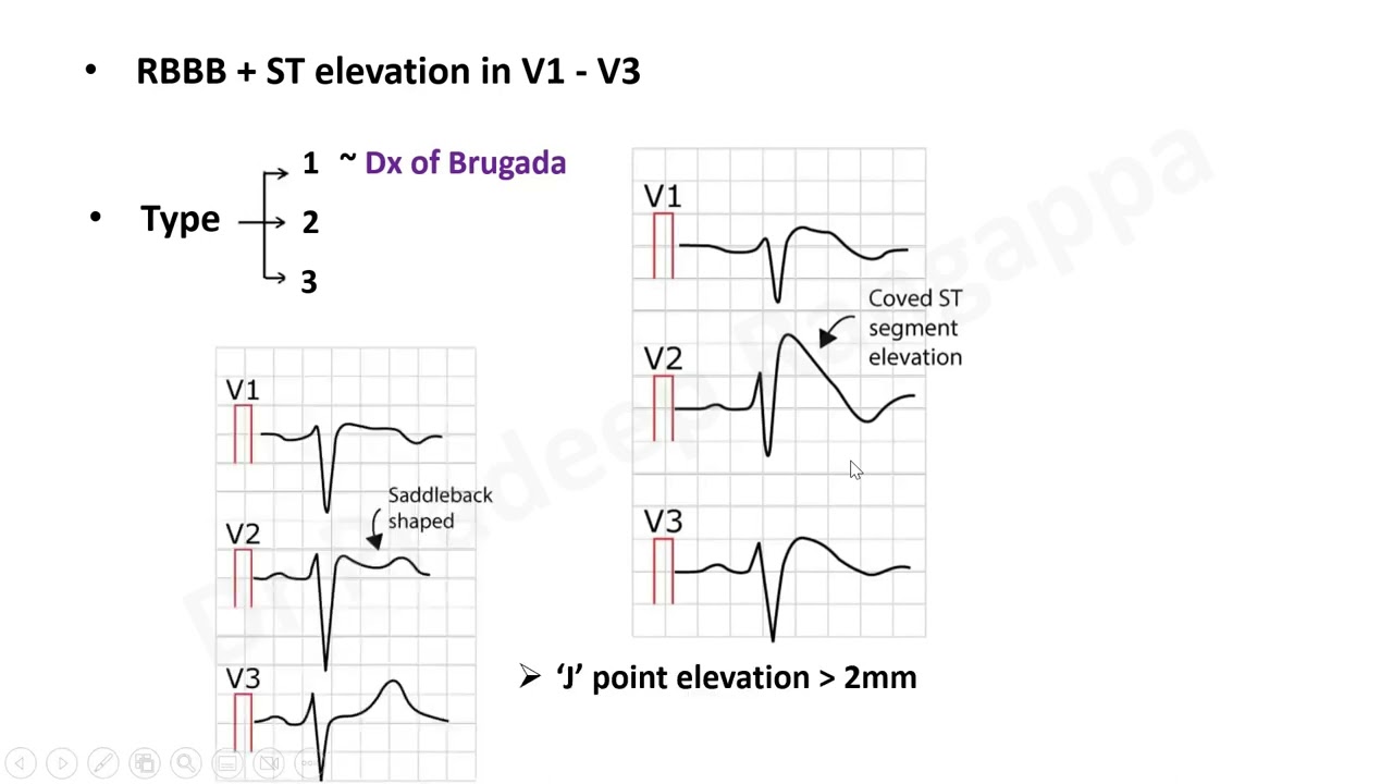Brugada Syndrome_Overview_Trainee Tutorial_Dr Pradeep Rangappa