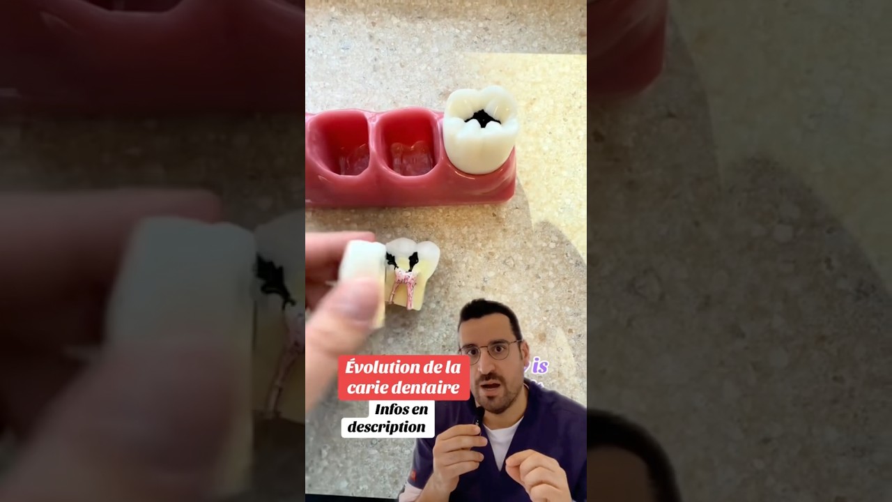 L&rsquo;&eacute;volution de la CARIE : de l&rsquo;&eacute;mail &agrave; la pulpe 🦷