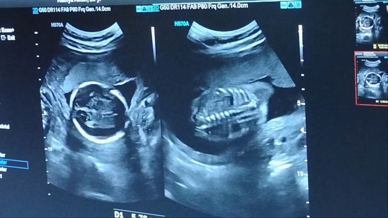 Naoaf ultrasound.
