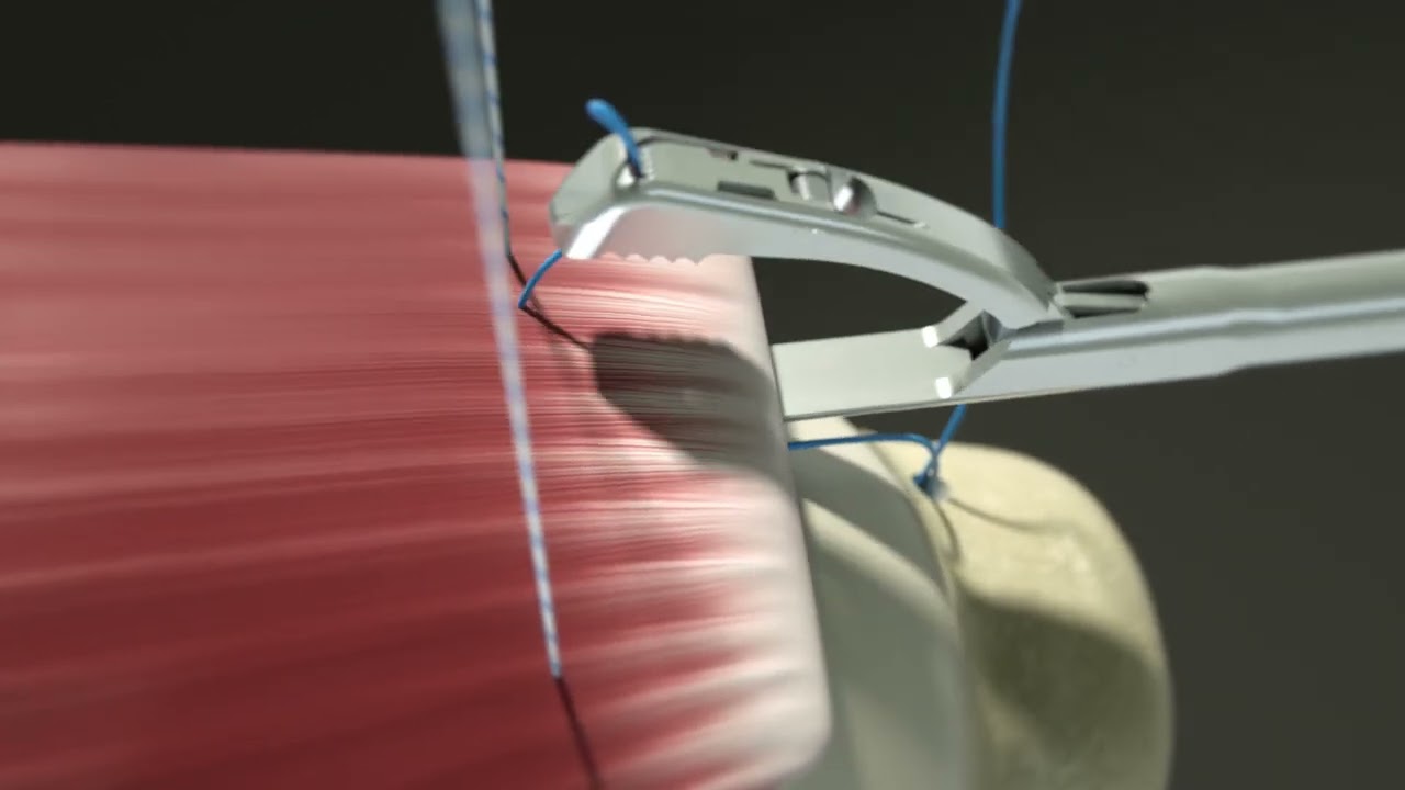 Rotator cuff repair animation with Iconix and ReelX