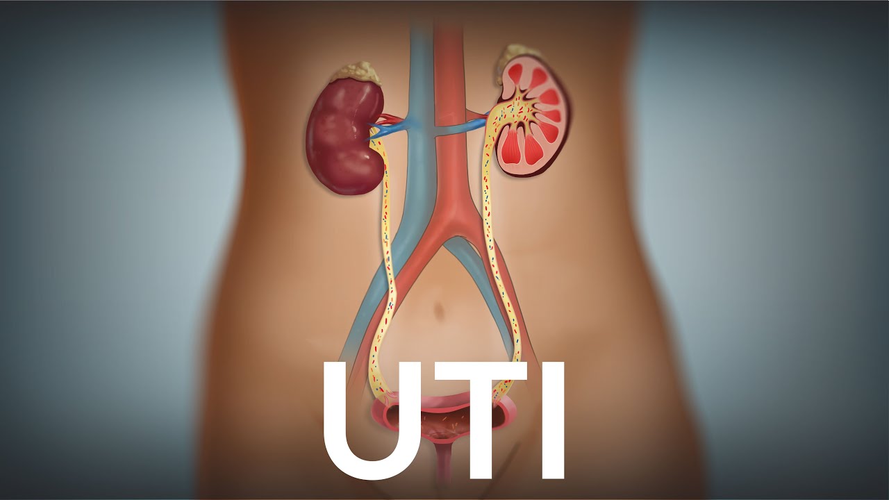 Urinary Tract Infection by E. Pingree | OPENPediatrics