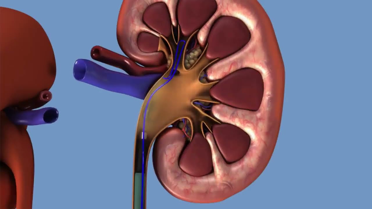 Removal of kidney stones  URS 3