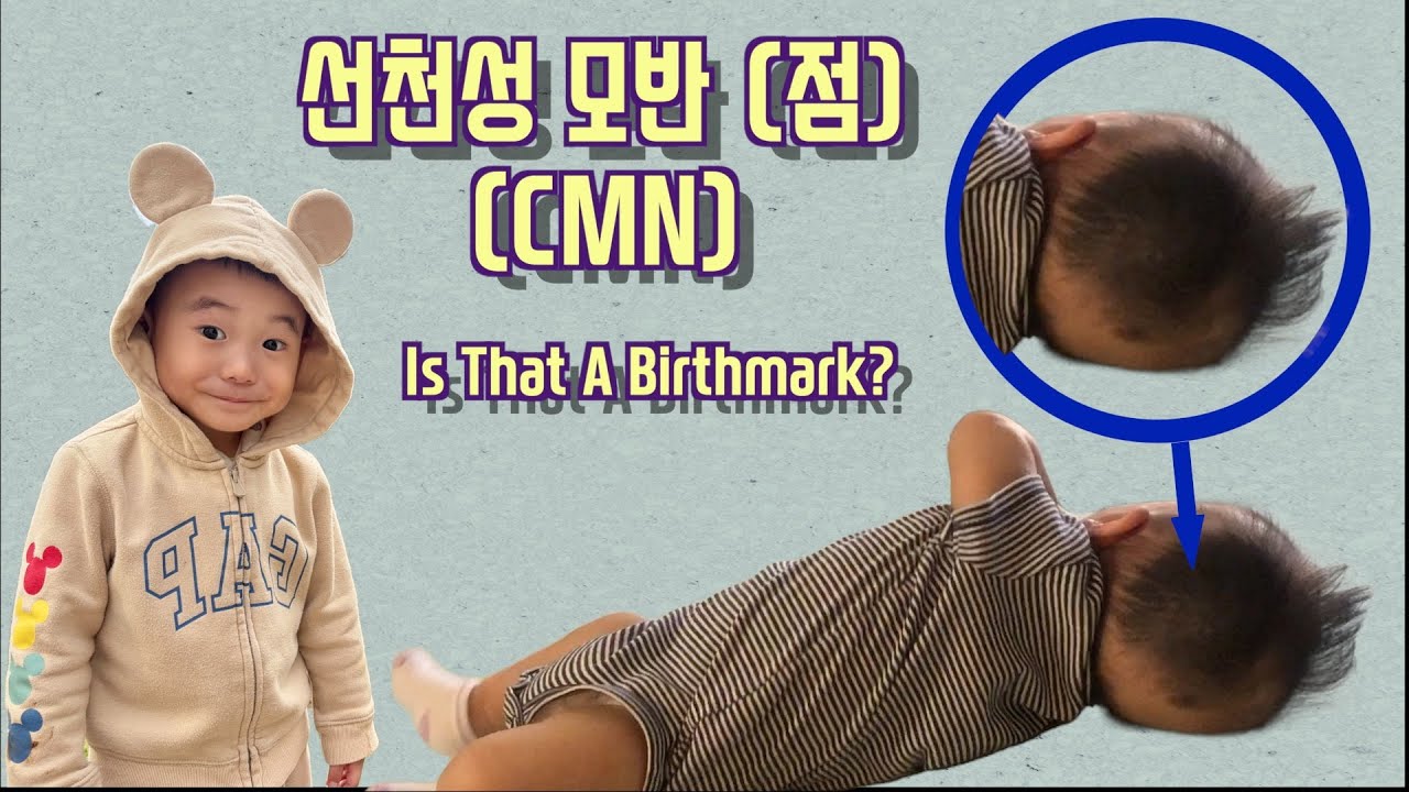 EP3. Is That a Birthmark? What We Thought Was a Bruise Turned Out to Be CMN 멍인줄 알았는데 알고보니 선천성 반점