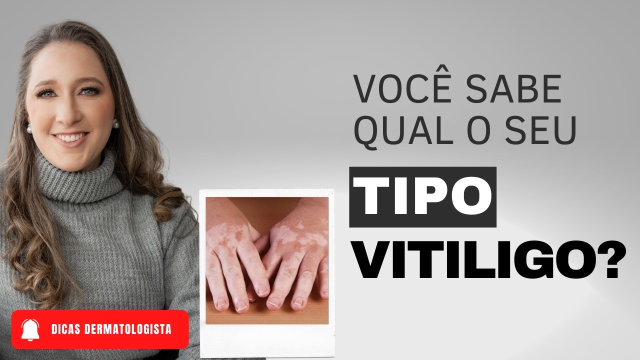 TIPOS DE VITILIGO - DERMATO DRA CAROLINA