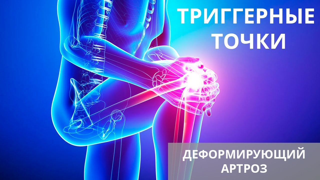 Триггерные точки и деформирующий артроз