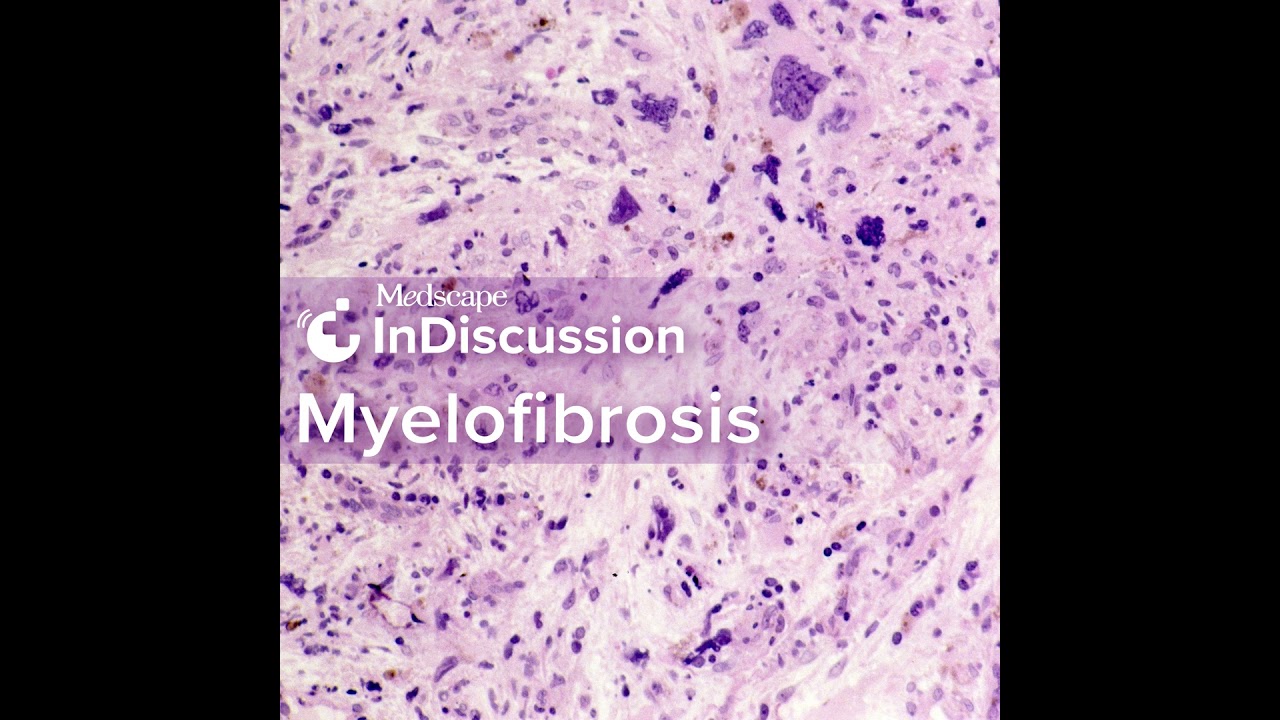 S2 Episode 3: Can We Prevent Myelofibrosis? The New Interferon Era