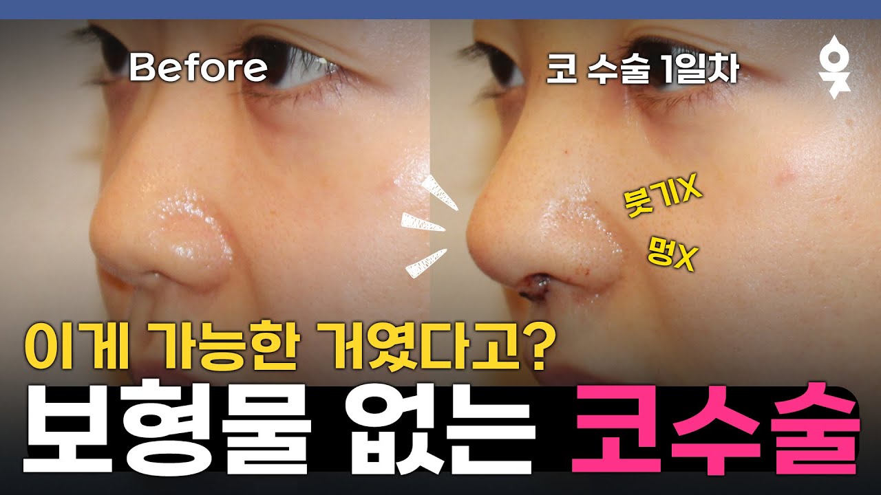 실리콘❌ 코수술 후 바로 일상생활 가능! 하루 만에 예뻐지는 코수술 비결