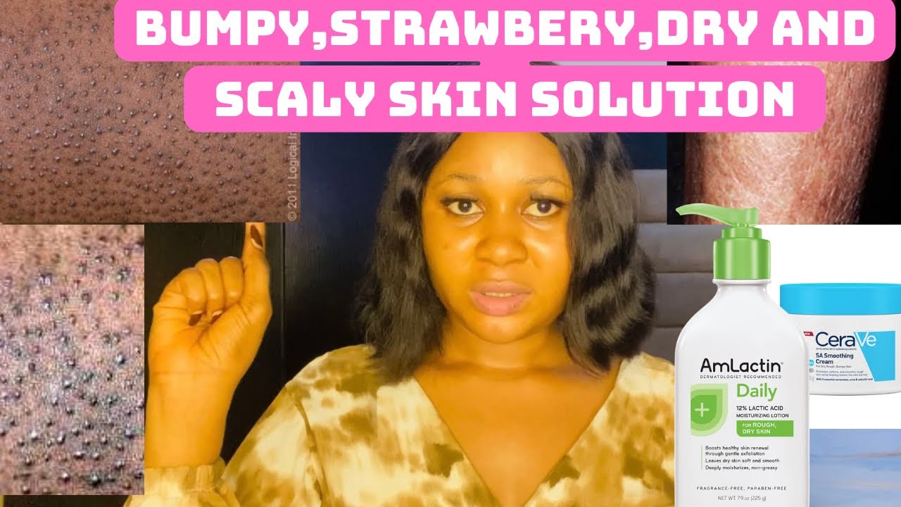 BEST BODY LOTIONS FOR ROUGH AND STRAWBERRY SKIN (immediate solution)