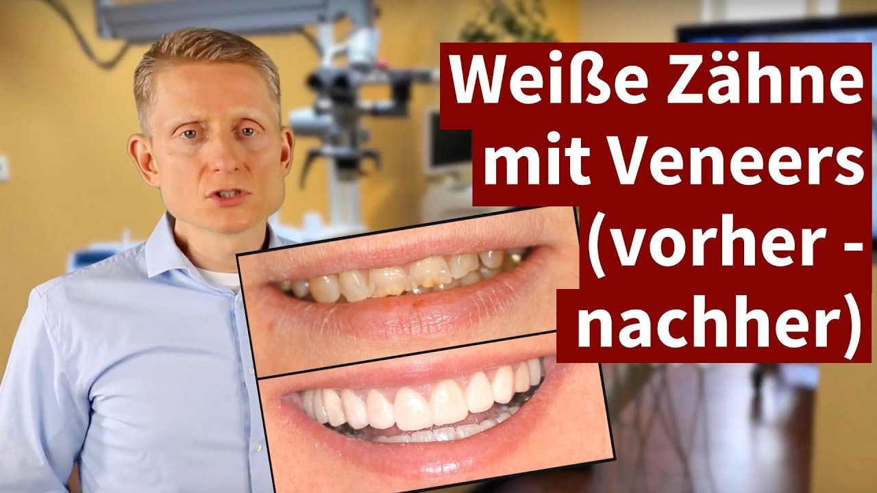 Weiße Zähne mit Veneers (vorher - nachher) 2021
