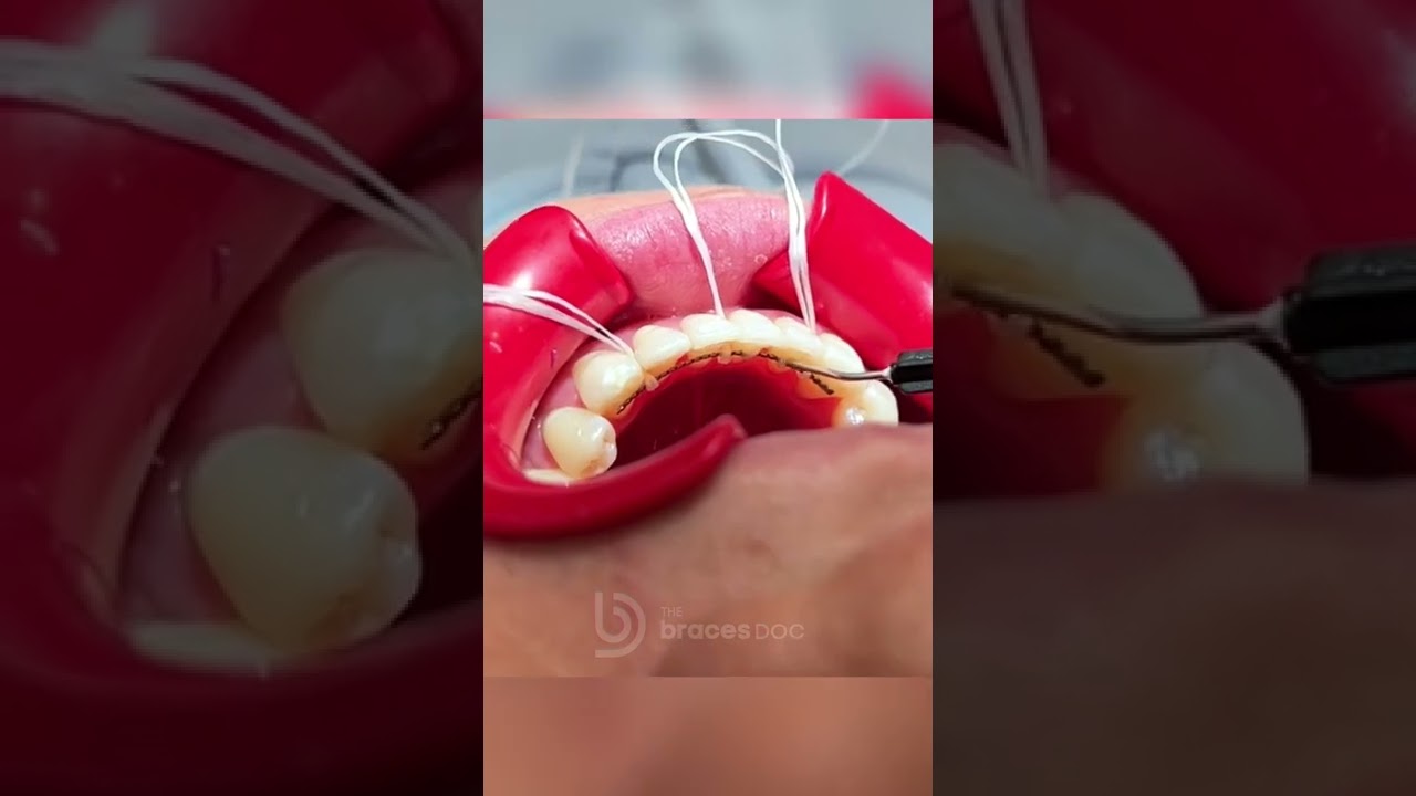 Bonding a fixed or &ldquo;permanent&rdquo; retainer - w/ The Braces Doc