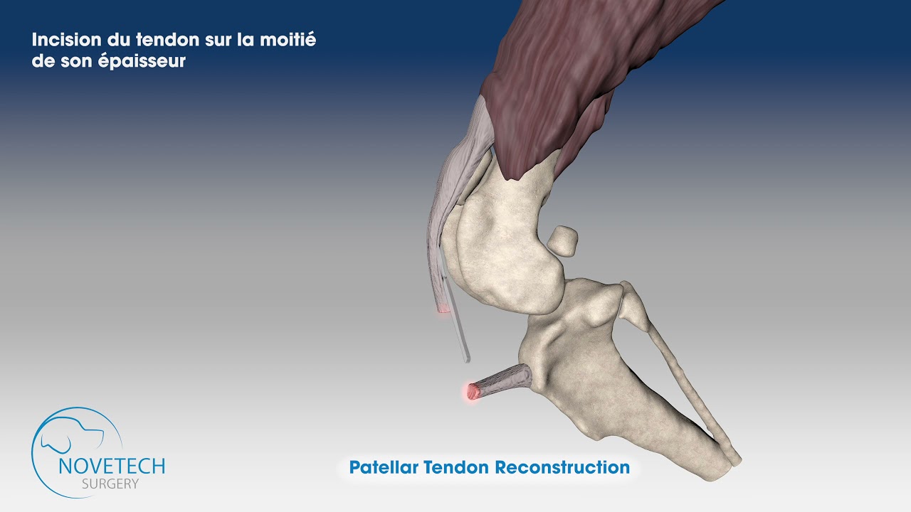 Reconstruction du Tendon Patellaire avec NOVATEN®