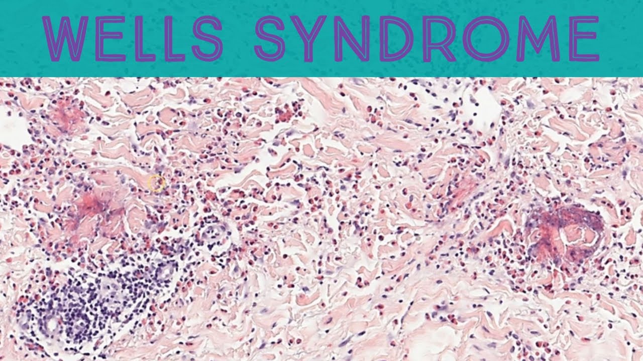 Wells syndrome (eosinophilic cellulitis) with flame figures (pathology dermatology dermpath)
