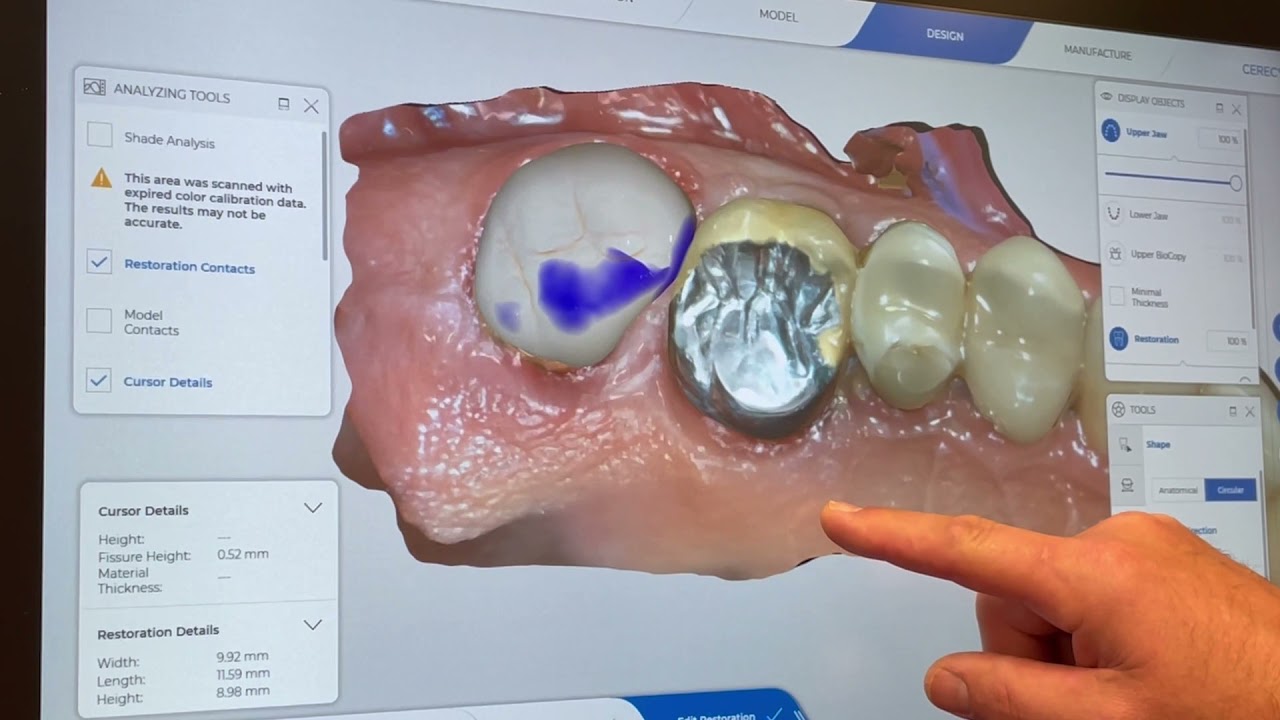 Cerec Tessera Workflow