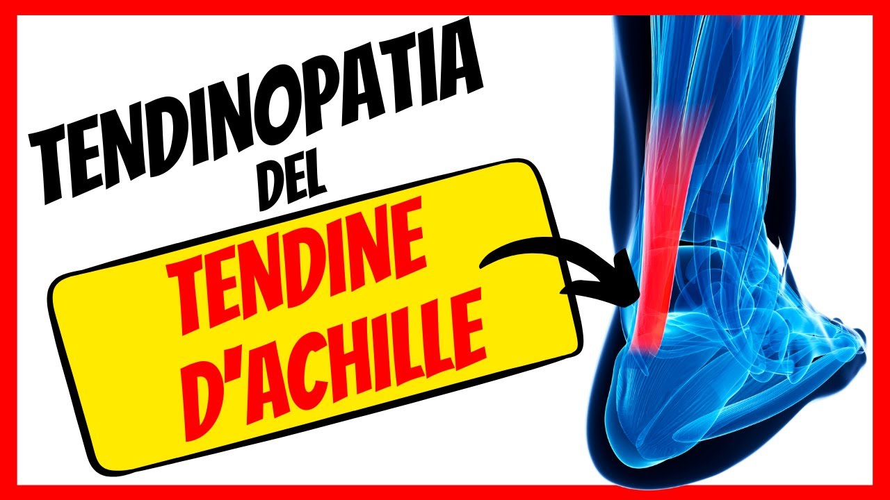 TENDINOPATIA ACHILLEA 🔺 Infiammazione tendine d'Achille: cos'è e come si cura