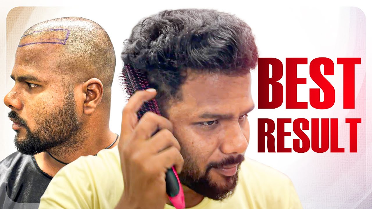 Receding Hairline Transplant: STUNNING RESULTS 🔥 | Hair Transplant Raipur | New Roots