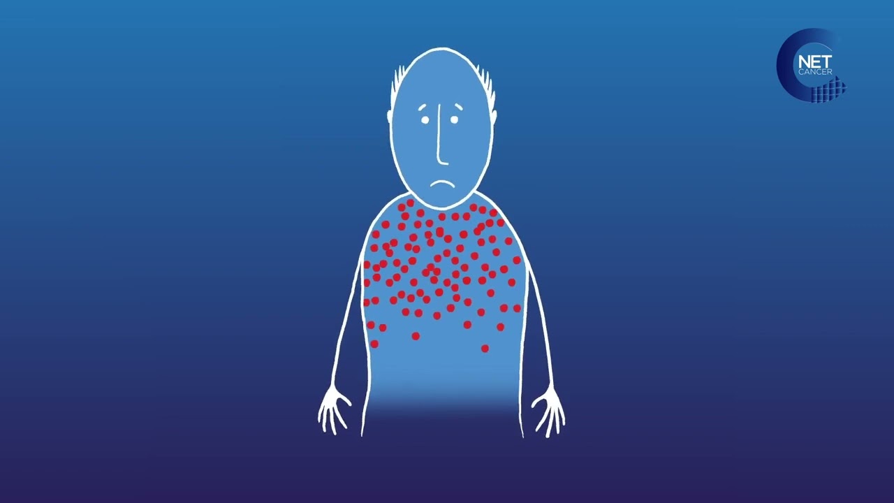 Les effets indésirables les plus fréquents du Sorafenib