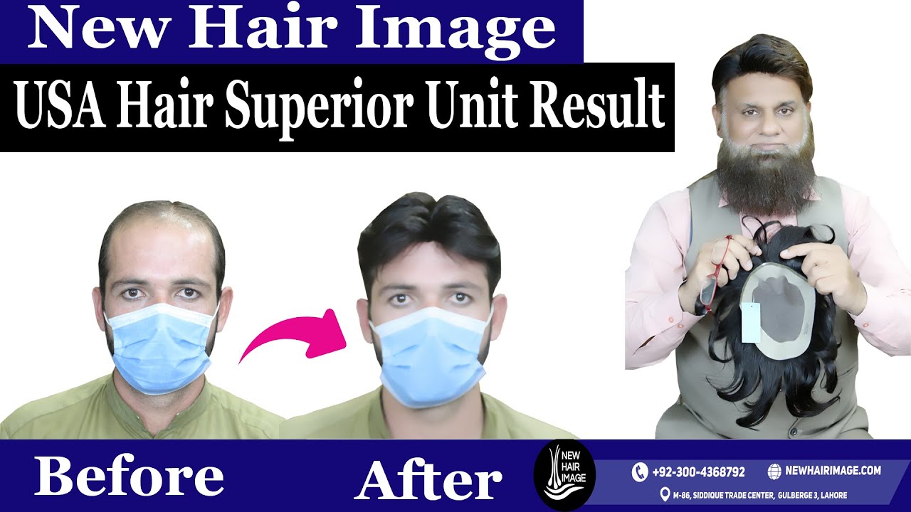 Best Hair Patch  : how to fix monofilament hair patch with double sided tape and lace hold glue