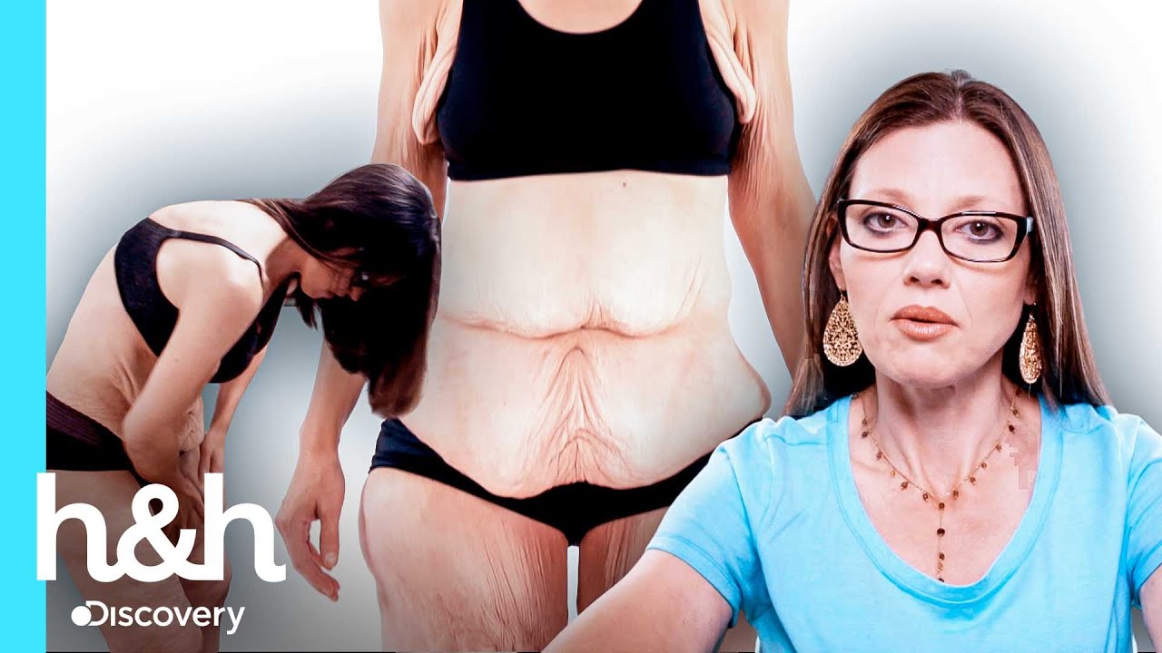 Perdió 120 kilos y ahora su piel le impide toda clase de movimiento | A la Medida | Discovery H&H