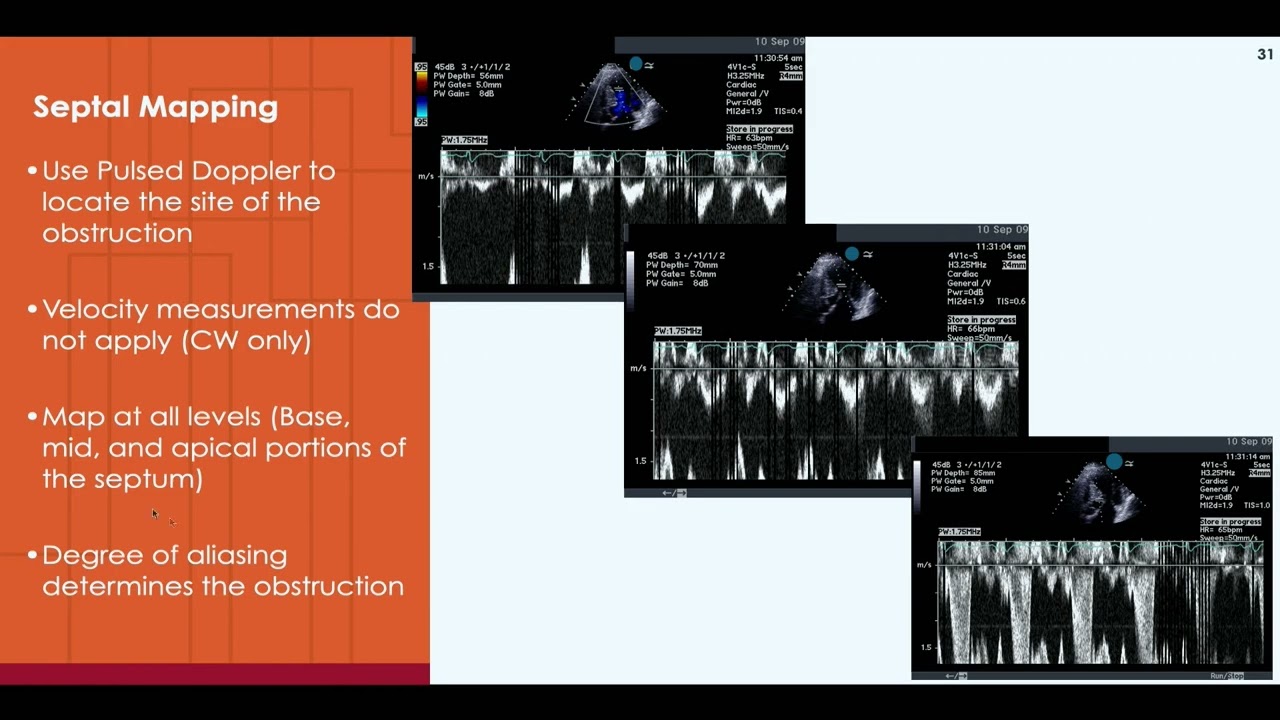 Echo Evaluation of Cardiomyopathies-SAMPLE-PW Doppler determine location of obstruction