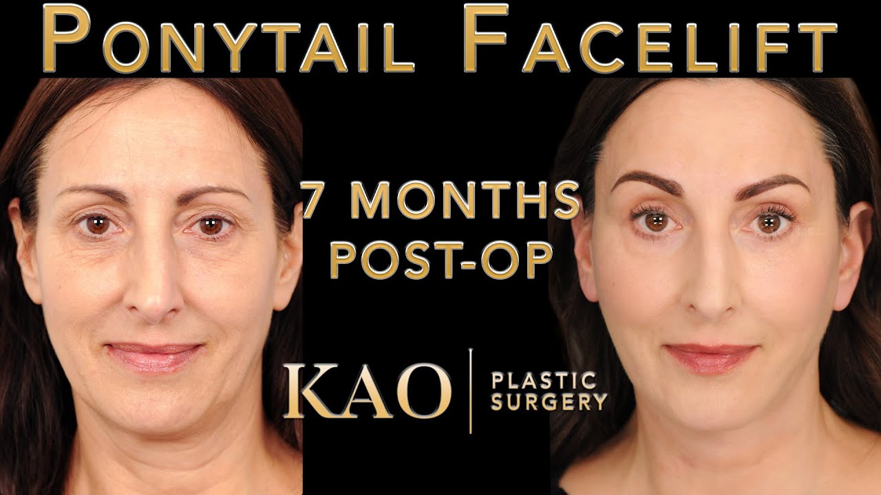 Ponytail Facelift Before And After Video - eyebrow Lift - Plastic Surgery Cost? The Art