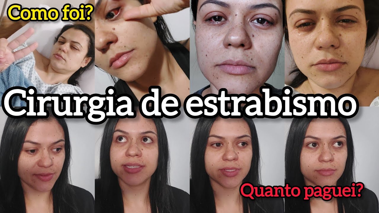 Minha cirurgia de estrabismo #estrabismo #cirurgia #cirurgiaestrabismo