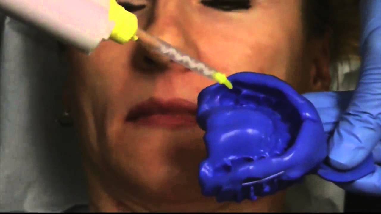 Diagnostic Impression with Virtual from Ivoclar