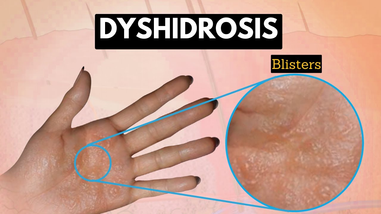 Dyshidrosis, Causes, Signs and Symptoms, Diagnosis and Treatment.