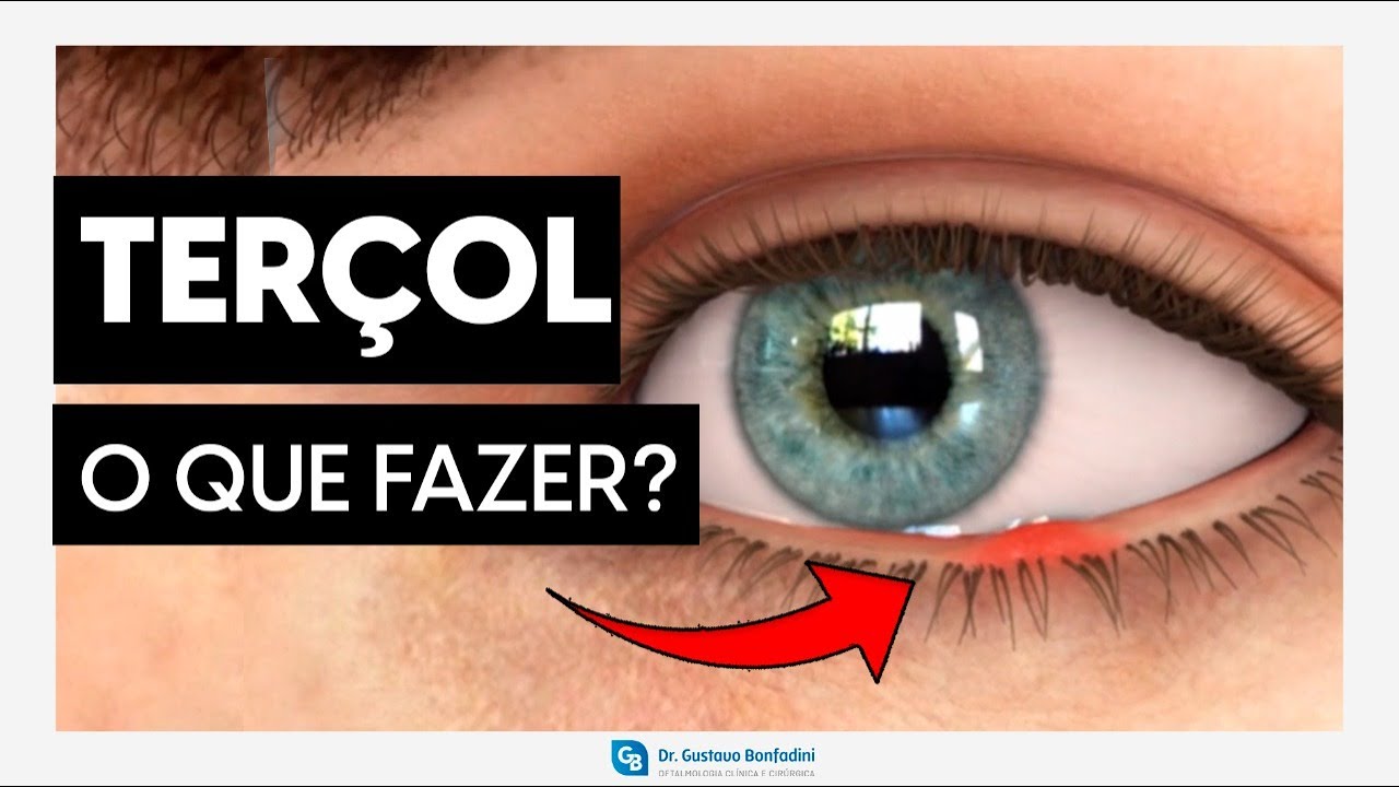 Descubra como curar o ter&ccedil;ol rapidamente! &ndash; Dr. Gustavo Bonfadini