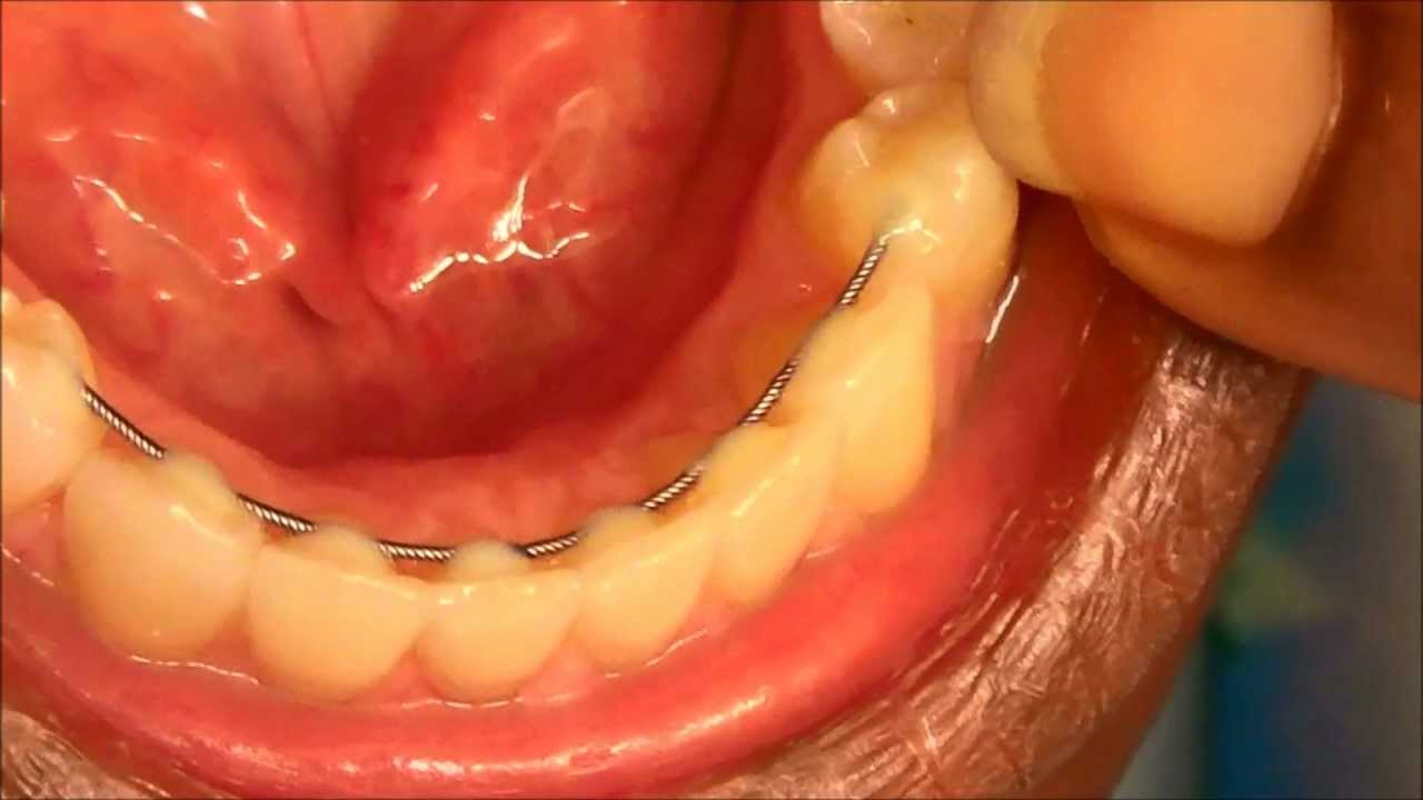 {#130} MY PERMANENT RETAINERS ON MY TOP AND BOTTOM TEETH