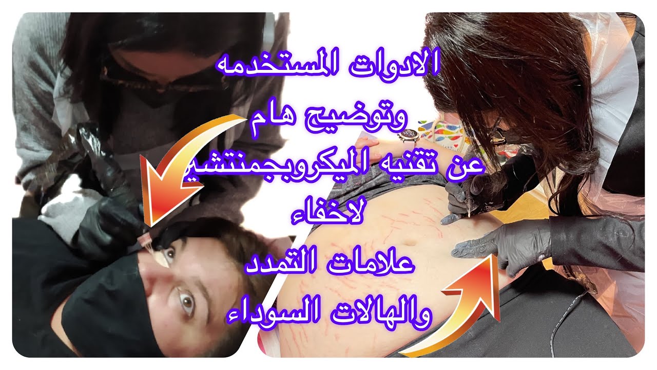 الادوات المستخدمه وتوضيح هام عن تقنيه الميكروبجمنتيشين لاخفاء علامات التمدد وازاله الهالات السمراء
