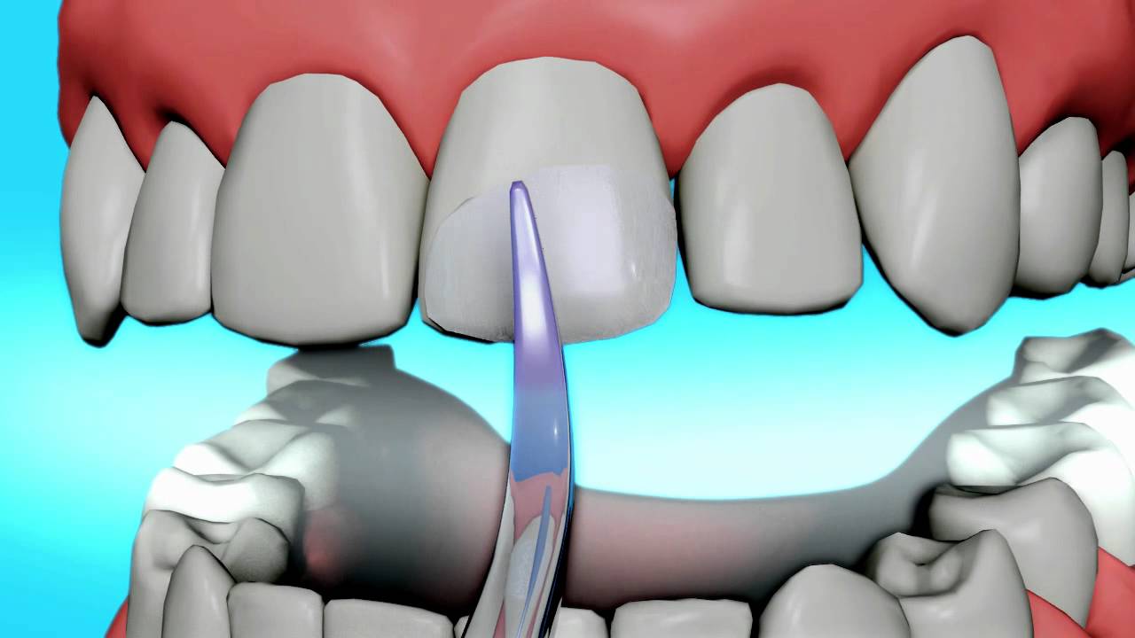 Dental Bonding Video | Tooth Bonding