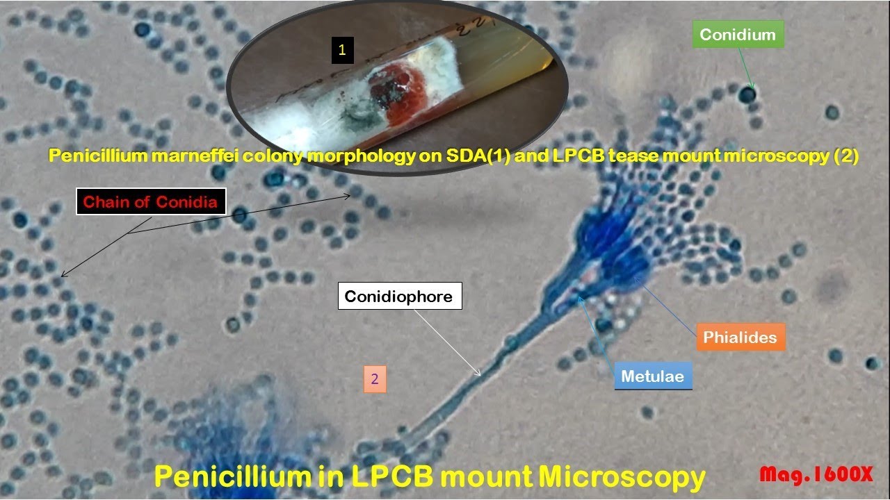 Penicillium marneffei colony morphology on SDA and LPCB tease mount Microscopy