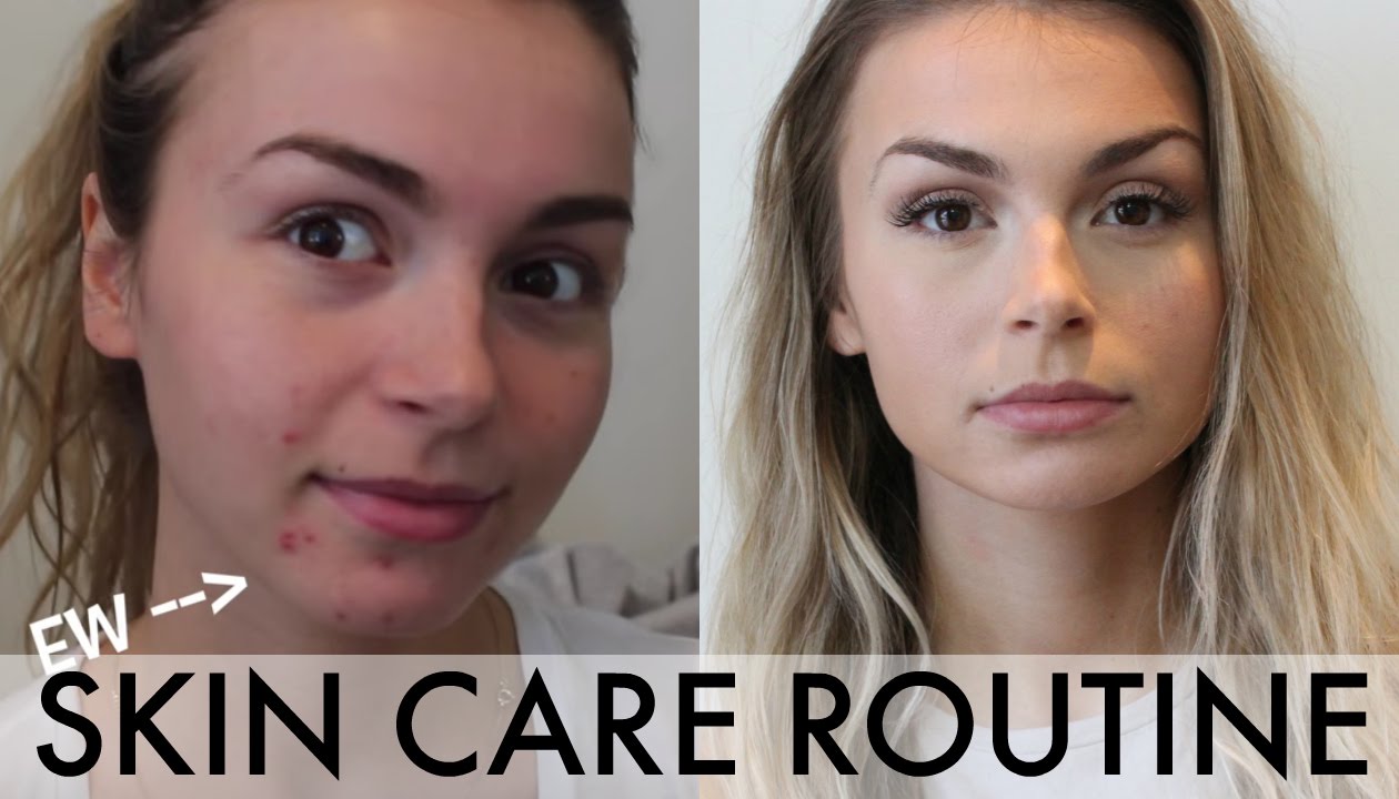 My Skin Care Routine (How to Clear Cystic Acne)