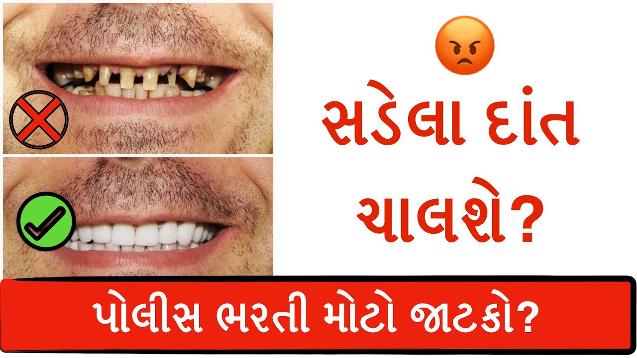 પોલીસ ભરતી માં સડેલા દાંત ચાલશે? |Gujarat Police bharati 2021| Gujarat Police PSI medical test