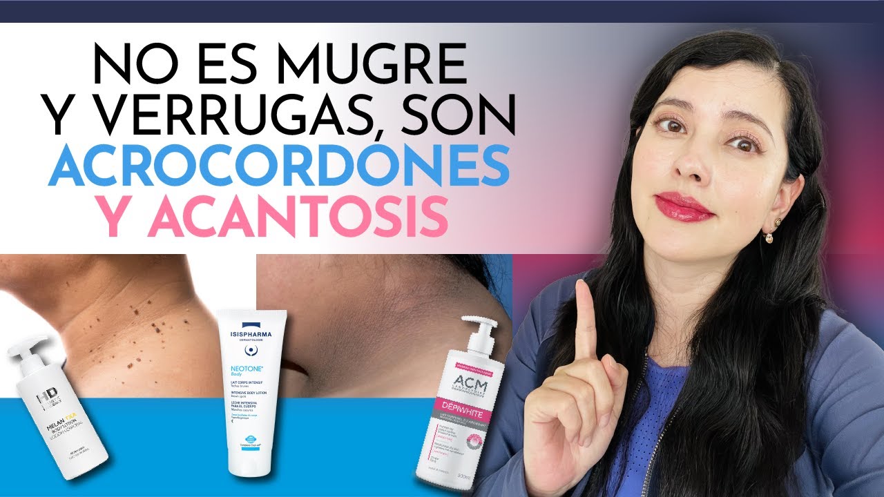 NO ES MUGRE Y VERRUGAS EN EL CUELLO, ES ACANTOSIS Y ACROCORDONES 👩🏻‍⚕️😱🤝🏻