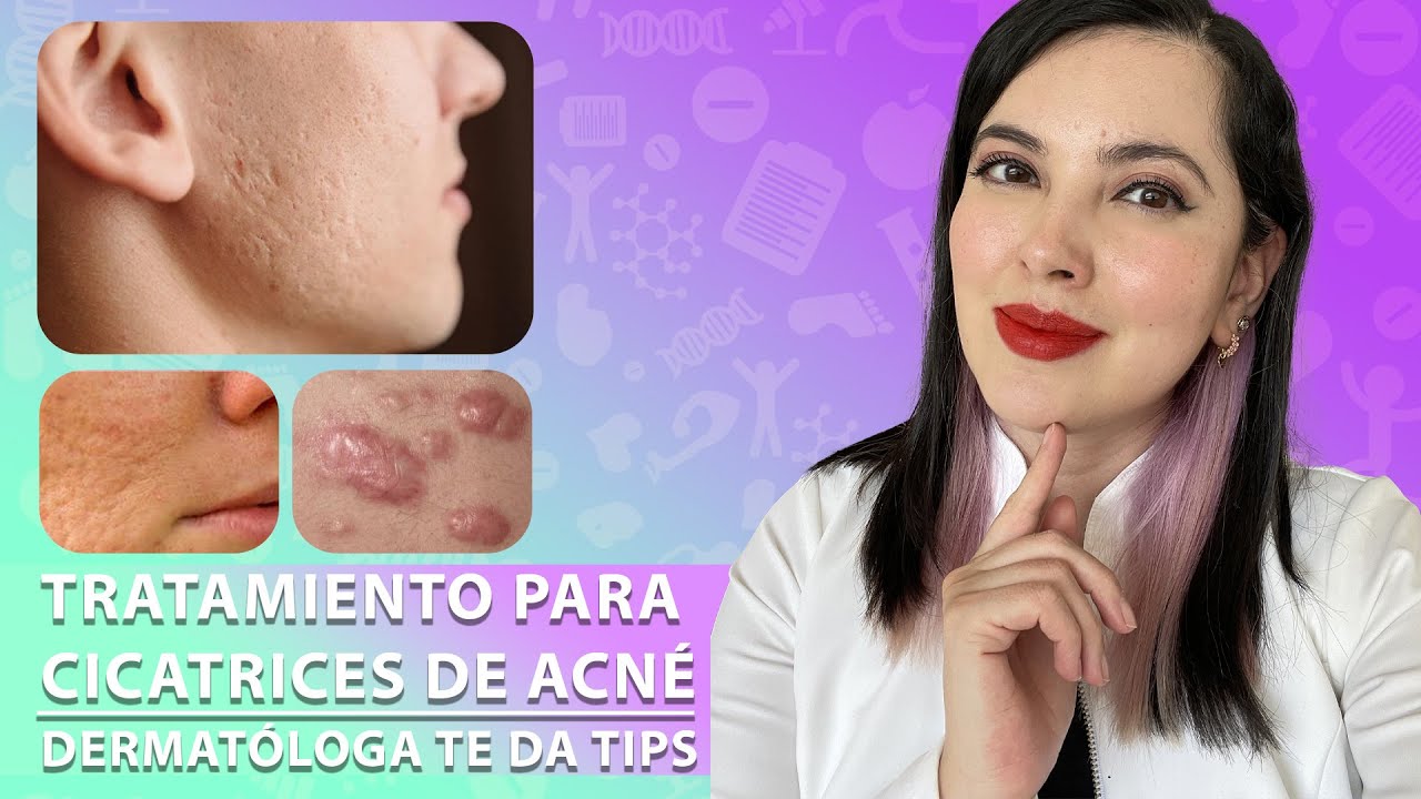 Como se tratan las CICATRICES DE ACNÉ. Tips de una Dermatóloga 👩🏻‍⚕️