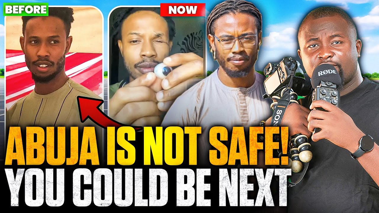 How I lost my eye because I live in Abuja