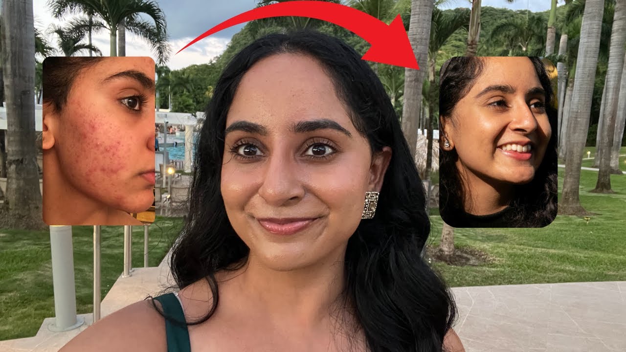 The ONE thing I stopped doing that cleared my skin
