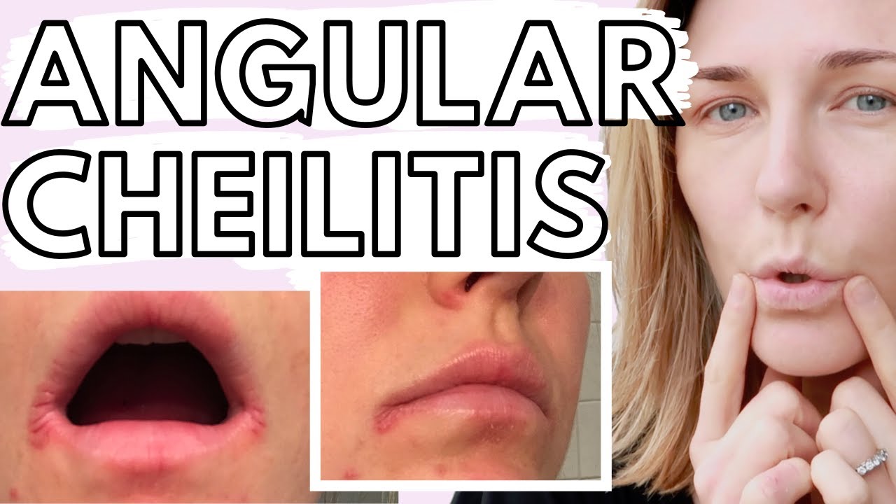 Lip Eczema & Angular Cheilitis - 10 TIPS for Dealing with Eczematous Angular Cheilitis