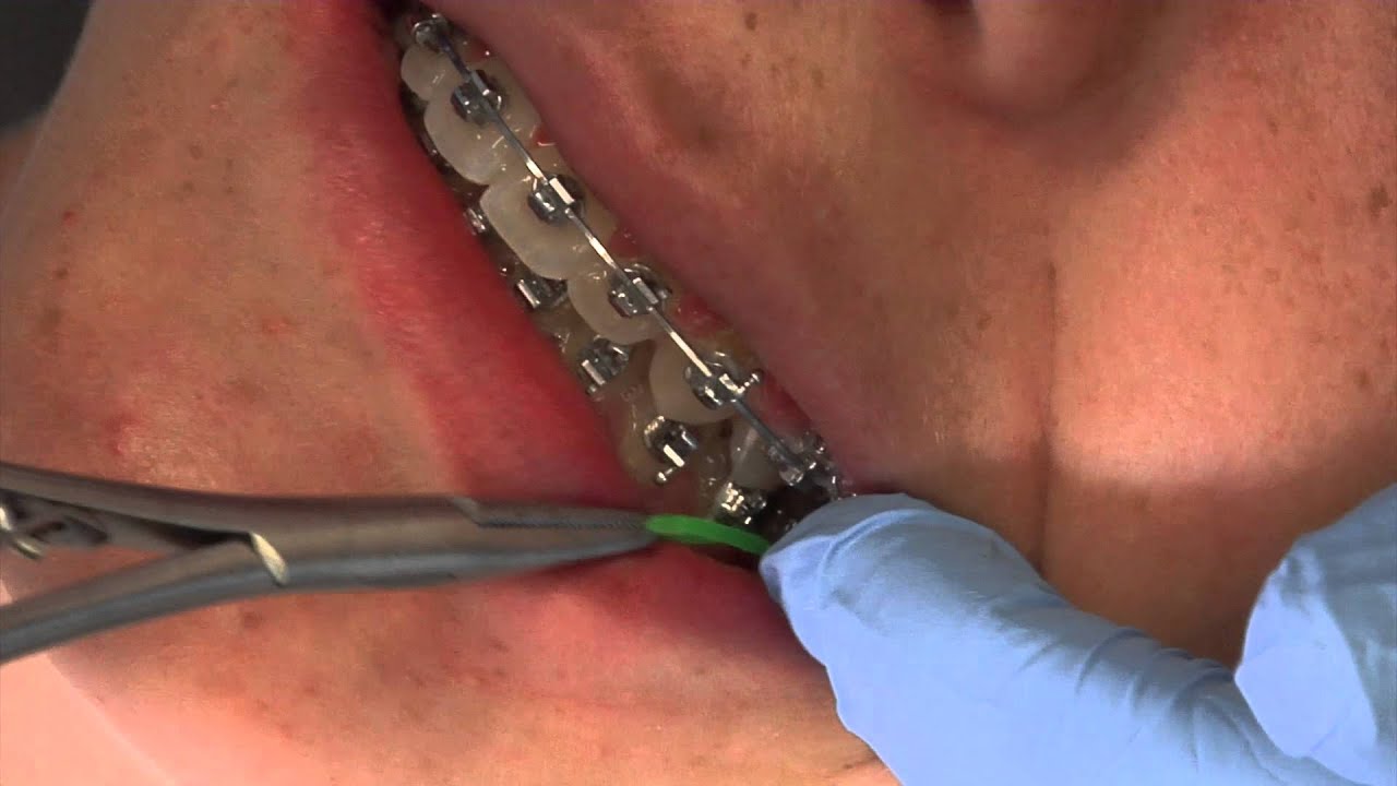 Elastics
