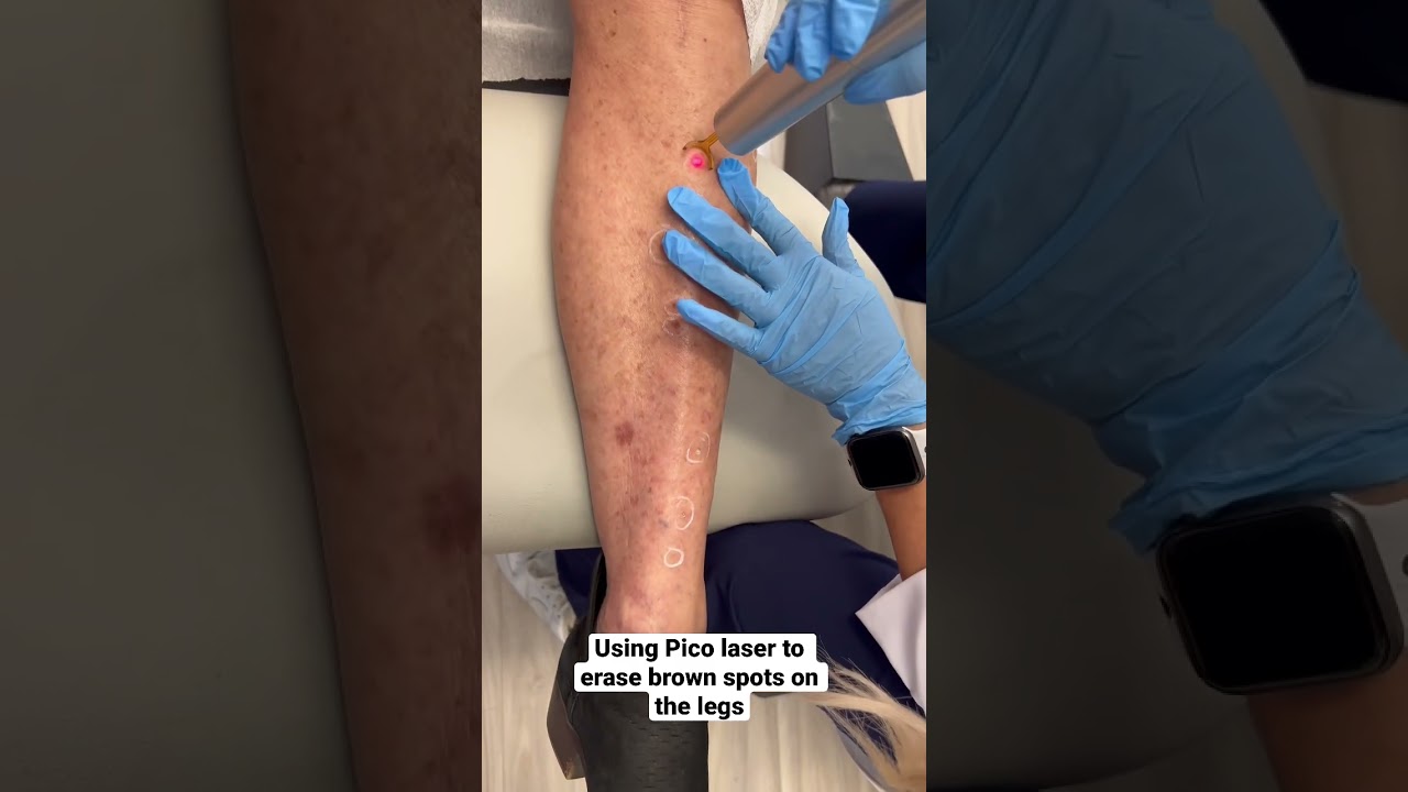 Erasing brown spots with PicoSure 💥💥💥#laser #pico #shorts