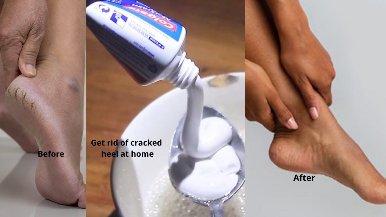 How to get rid of cracked heels easily/ Ubu buryo bwagufasha gukira imyate vuba kandi buroroshye