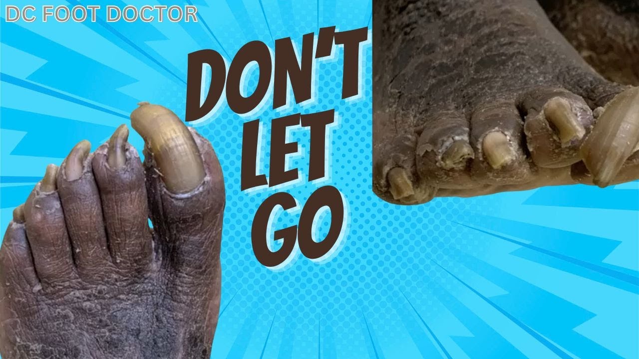 Don't Let Go: Trimming Long Fungal Toenails